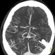 Occlusion of middle cerebral artery, MCA, collateral flow, postischemic changes: CT - Computed tomography
